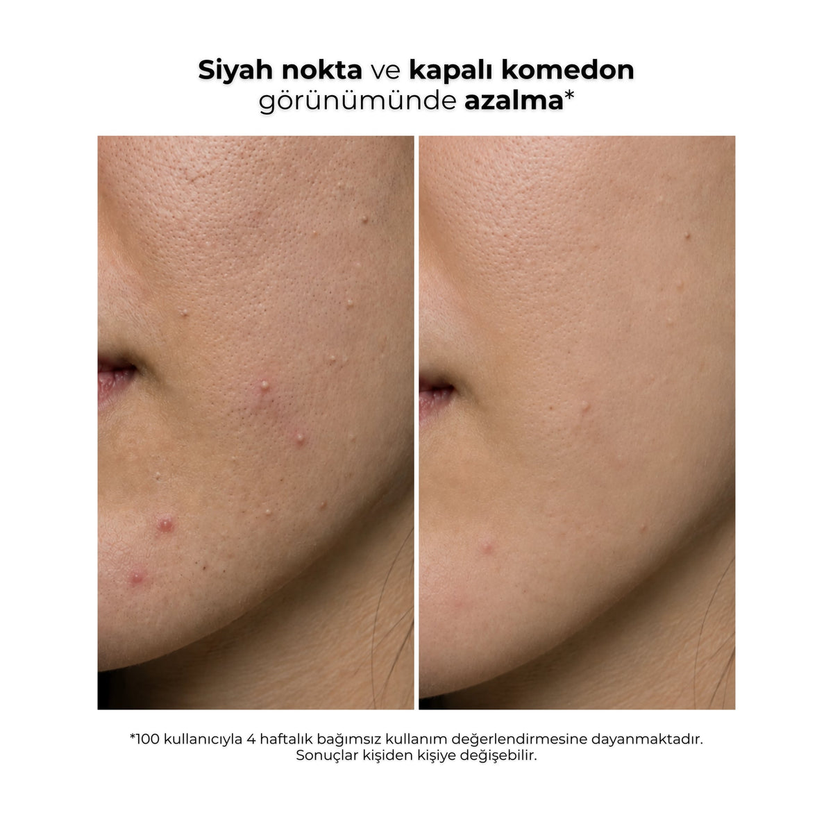 Ginseng Peeling kullanıcısının önce ve sonra cilt görünümü